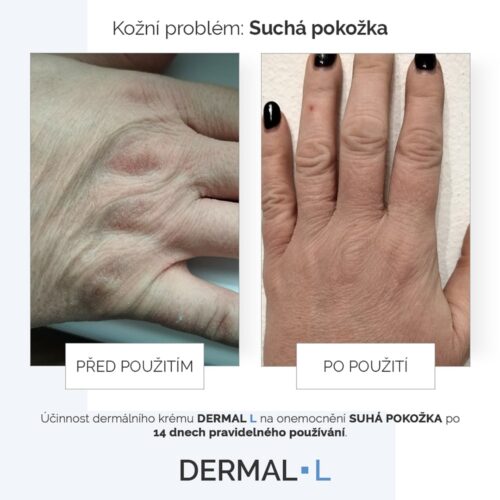 Suchá pokožka rukou po pravidelném používání DERMAL L